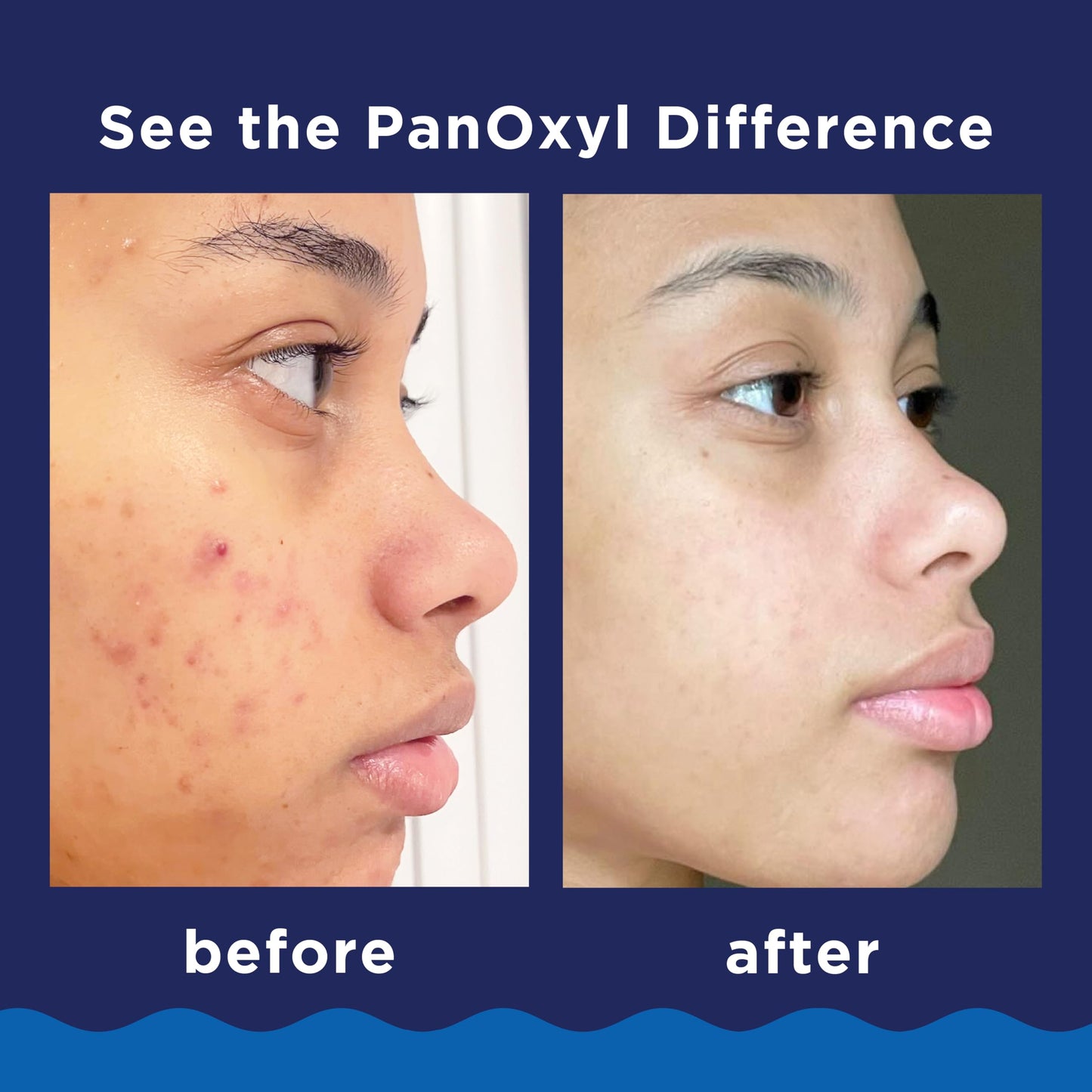 Panoxyl Acne Wash